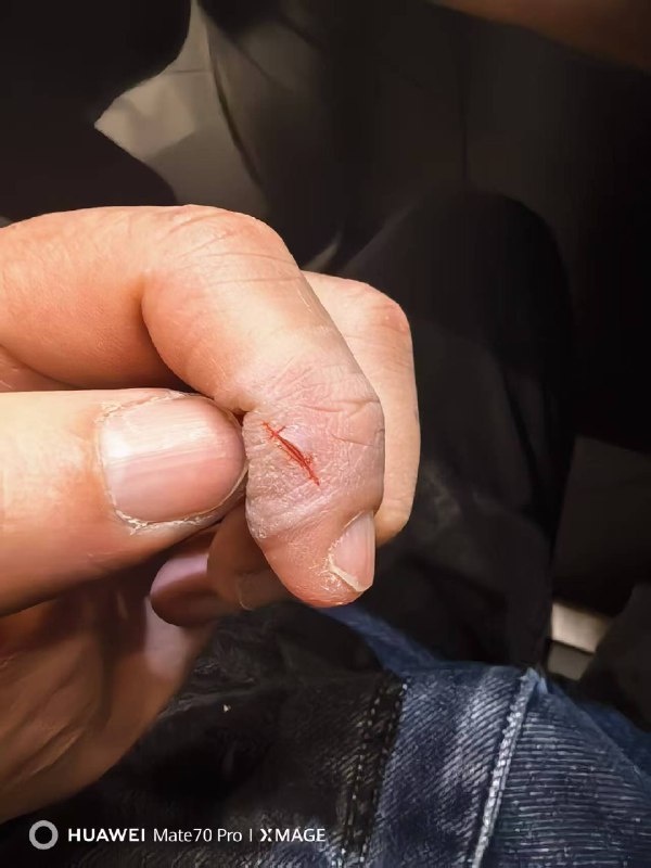 #随记 年龄大了，各种毛病都出来了！以前，到了冬天的时候，手会掉皮干燥、脚会干燥，一个多月时间就会好